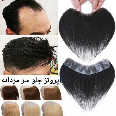 پروتز مو جلو سر