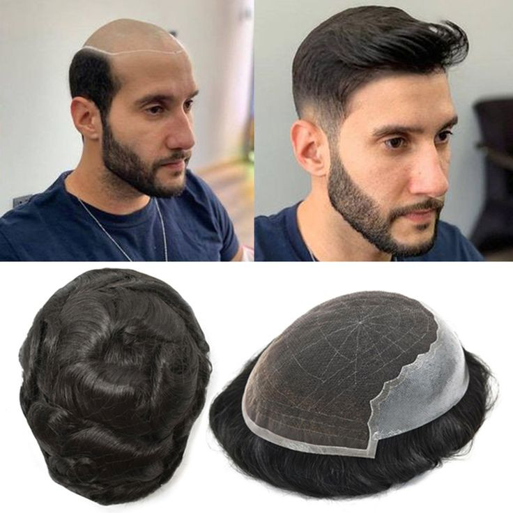 عمر پروتز مو