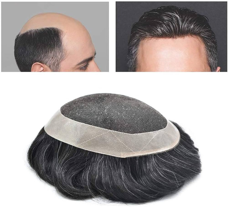 پروتز مو مردانه نیوزلندی